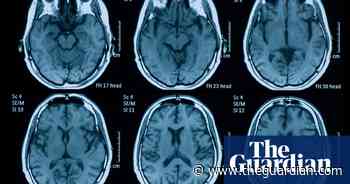 Covid can shrink brain and damage its tissue, finds research - The Guardian