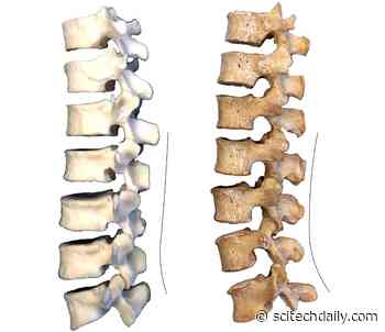 What Explains Our Lower Back Pain? Anthropologists Turn to Neanderthal Spines for Answers