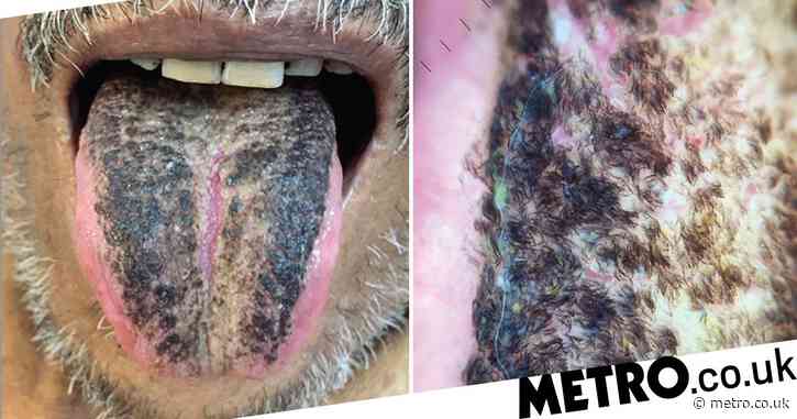 Stroke victim's tongue turns black and hairy after he is put on pureed diet