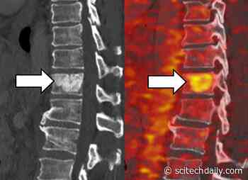 Treating Tough Tumors by Exploiting Cancer Cells’ Iron “Addiction”