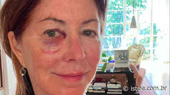 Atriz cai de escada e aparece com o olho roxo: 'Fiquei com medo' - ISTOÉ Independente - ISTOÉ