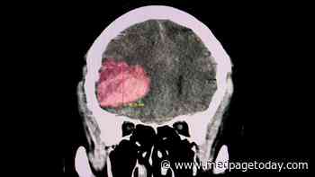 More Clues Emerge for Brain Bleed Prognosis