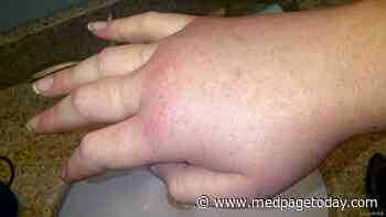 Antisense Drug Slashed Hereditary Angioedema Attacks in Small Study