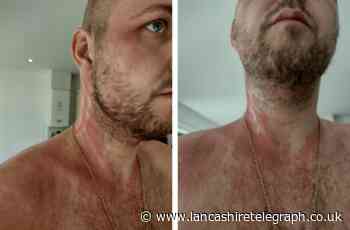 'Like an acid burn down my neck' - Ribble Valley man suffers horrific reaction to baby shampoo