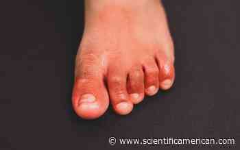 Are 'COVID Toes' Actually Caused by the Coronavirus? - Scientific American