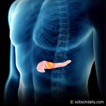 New Screening Tool Identifies 95% of Stage 1 Pancreatic Cancer
