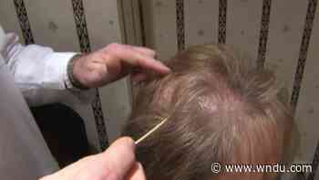 Medical Moment: What is alopecia? - WNDU