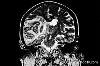 COVID-19’s Severe Impacts on the Brain – Even in People That Did Not Experience Serious Respiratory Symptoms