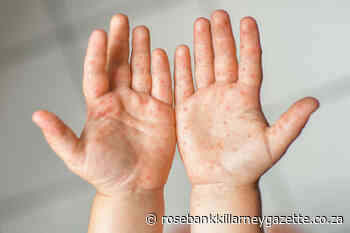 All about Hand, Foot, and Mouth disease in kids - Rosebank Killarney Gazette