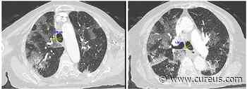 Coronavirus Disease 2019-Induced Tracheomegaly: A Case Report - Cureus