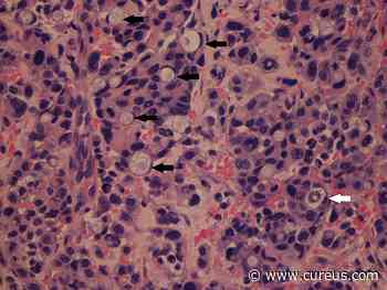 A Trail to Diagnosis—Finding the Primary Lesions of Bone Metastasis - Cureus