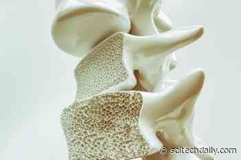 Levels of a Hormone Could Predict or Detect Bone Loss in Premenopausal Women