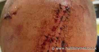 Man 'attacked' with metal bar and glass bottle in east Hull - Hull Live