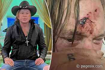 Mickey Rourke reveals gruesome gash on his head - Page Six