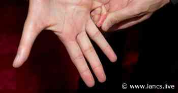 Having longer fingers mean you could be sicker with coronavirus - Lancs Live