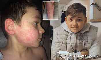 Basildon boy, 14, 'could die if he walked to school' because he's 'allergic' to the cold - Daily Mail