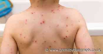 Parents warned about rising risk of chickenpox and scarlet fever - Grimsby Live