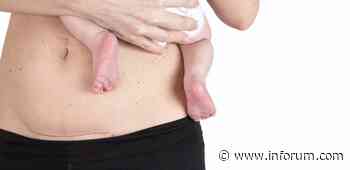 How physical therapy delivers the most effective post-C-section care - INFORUM