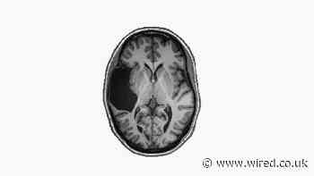 She Was Missing a Chunk of Her Brain. It Didn’t Matter