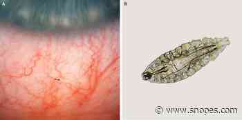 Doctors Pluck More Than a Dozen Maggots from Gardener's Eye - Snopes.com