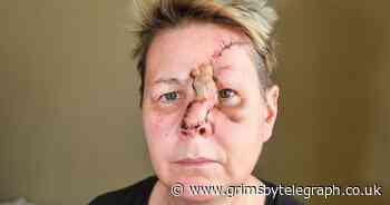 Grimsby woman's horrific injuries after being mauled by dog she was told was friendly - Grimsby Live