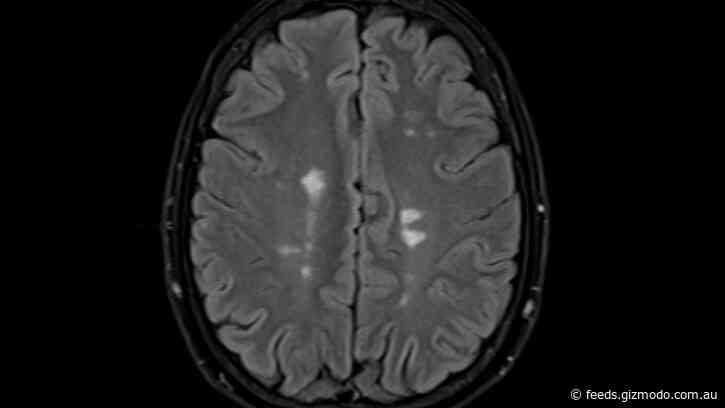 Promising Data Suggests New Multiple Sclerosis Therapy Could Halt or Reverse Symptoms