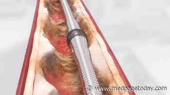 Bedside Heart Pump Insertion: No Trip to the Cath Lab Necessary?