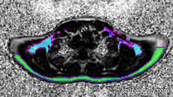 Energy-Burning Brown Fat Less Active in Boys With Obesity – Discovery May Lead to New Treatments