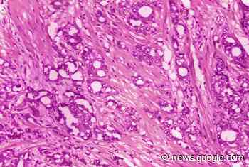 Doctors suggest new names for low-grade prostate cancer - The Associated Press