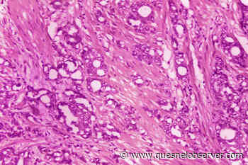 Doctors suggest new names for low-grade prostate cancer - Quesnel - Cariboo Observer