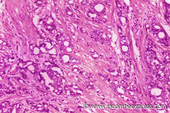 Doctors suggest new names for low-grade prostate cancer - Lacombe Express
