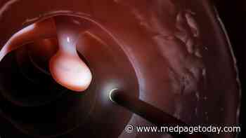 AI-Assisted Colonoscopy Missed Fewer Pre-Cancerous Polyps
