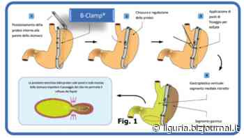 Obesità: all'Iclas di Rapallo il primo intervento in Liguria di gastroplastica verticale - Bizjournal.it - Liguria
