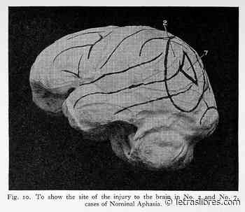 Afasia: la lucha de un cerebro contra la nada - LetrasLibres.com