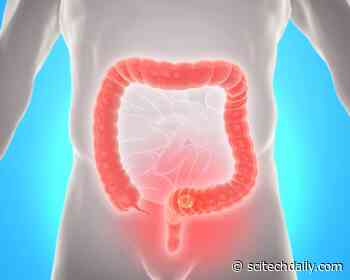 How To Lower Your Risk of Developing Colorectal Cancer  