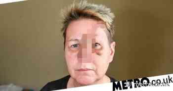 Grimsby: Dog rips skin off woman's nose when she tries to stroke it - Metro.co.uk