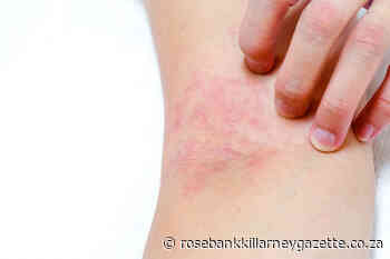 Treating Atopic Dermatitis in babies and children - Rosebank Killarney Gazette