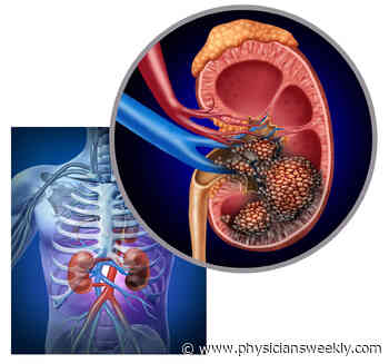 Renal Cell Carcinoma (RCC) Has a High Level of PD-L1+ & Hyal2+ Myeloid-derived Suppressor Cells - Physician's Weekly