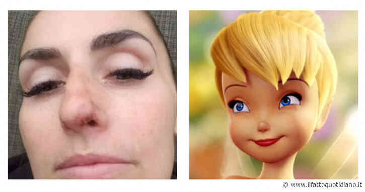 “Iniettarsi filler sulla punta del naso per assomigliare a Campanellino di Peter Pan”: la ‘moda estetica’ che preoccupa i medici. I rischi? Dalla necrosi alla cecità