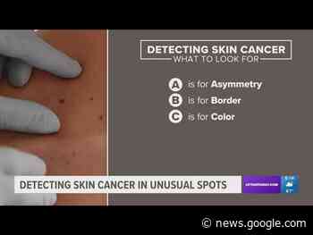 Quit putting off that skin cancer screening, doctors say - 10 Tampa Bay