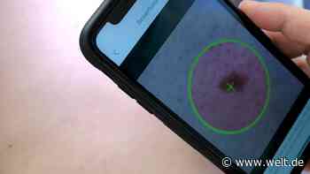 Gegen Hautkrebs soll jetzt eine App helfen – so gut funktioniert sie