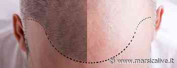 Trichobiolight: parte da Avezzano un protocollo innovativo per la ricrescita dei capelli - MarsicaLive