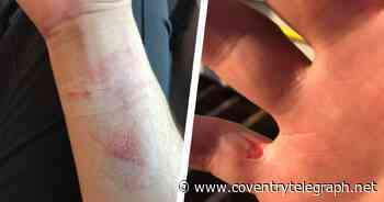 Cops 'head-butted, grabbed and bitten' during 'drug-induced' episode - Coventry Live