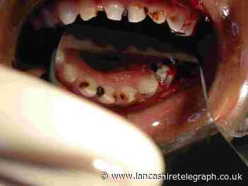Blackburn with Darwen dental treatment survey for mentally ill - Lancashire Telegraph