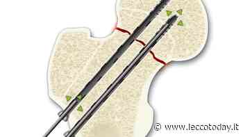 A Lecco una metodica innovativa per l’osteonecrosi che rigenera l’osso dall’interno - LeccoToday