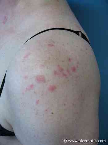 Comprendre les mécanismes du lupus, maladie rare, essentiellement cutanée et articulaire, qui touche principalement les femmes