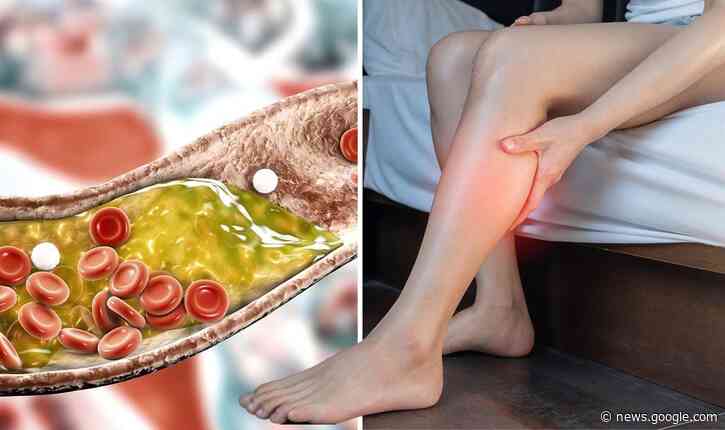 High cholesterol: The 'serious' signs in your legs that cholesterol has become ‘fatal' - Express