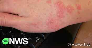 Schurft rukt op in Antwerpen: apothekers zitten zonder zalf, Tropisch Instituut heeft nog wel voorraad pillen - VRT NWS