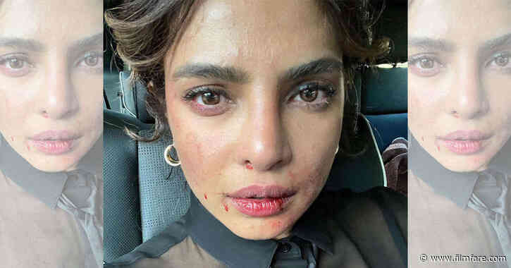 Priyanka Chopra Jonas shares a photo of her bruised face from the set of Citadel