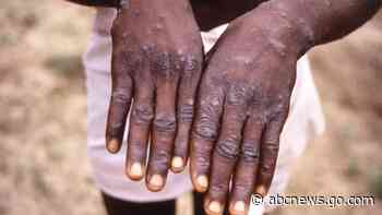 1st US case of monkeypox this year identified